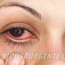 Saúde alerta sobre casos de conjuntivite em Viçosa